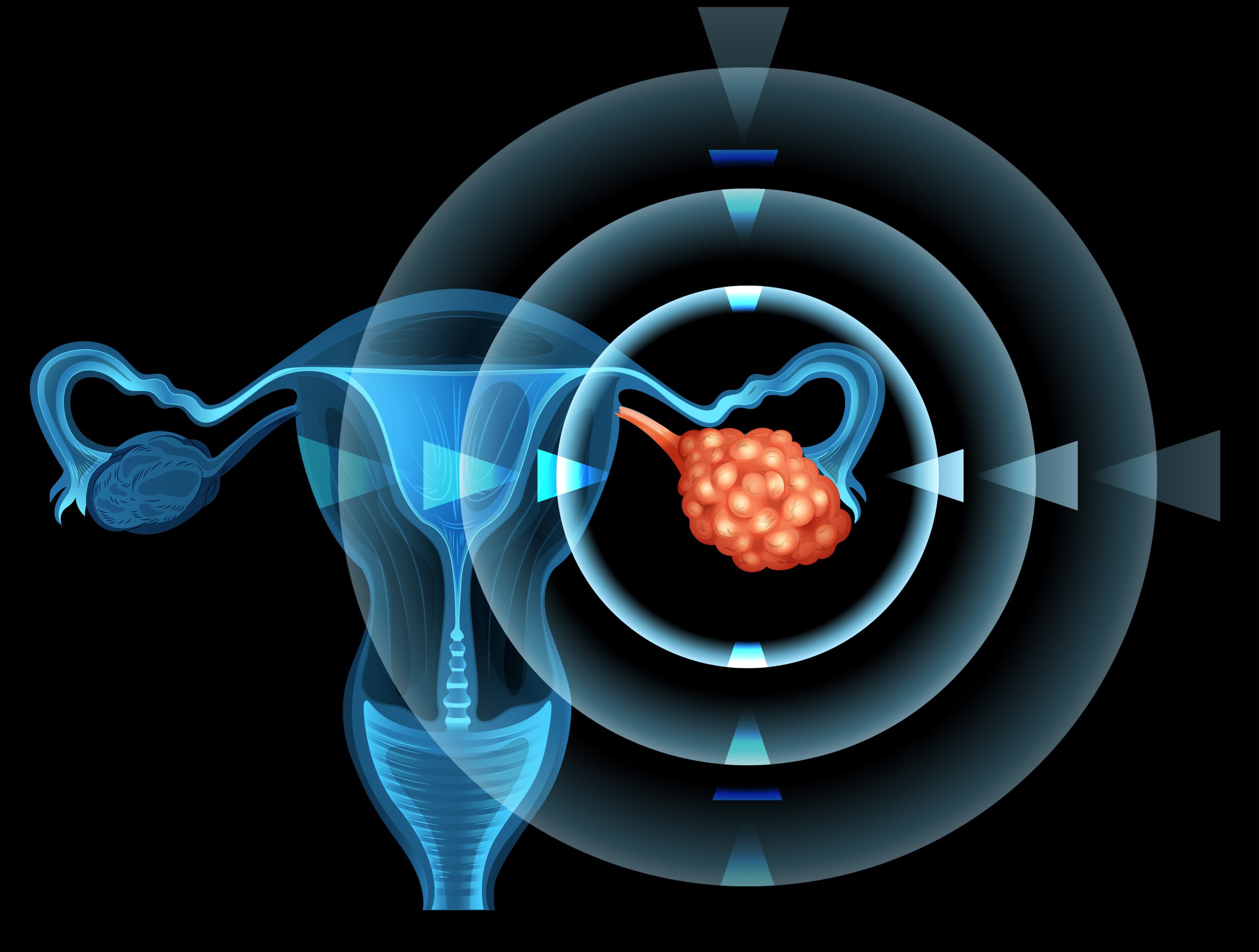No todos los quistes ováricos son cancerosos: lo que necesita saber para la detección temprana