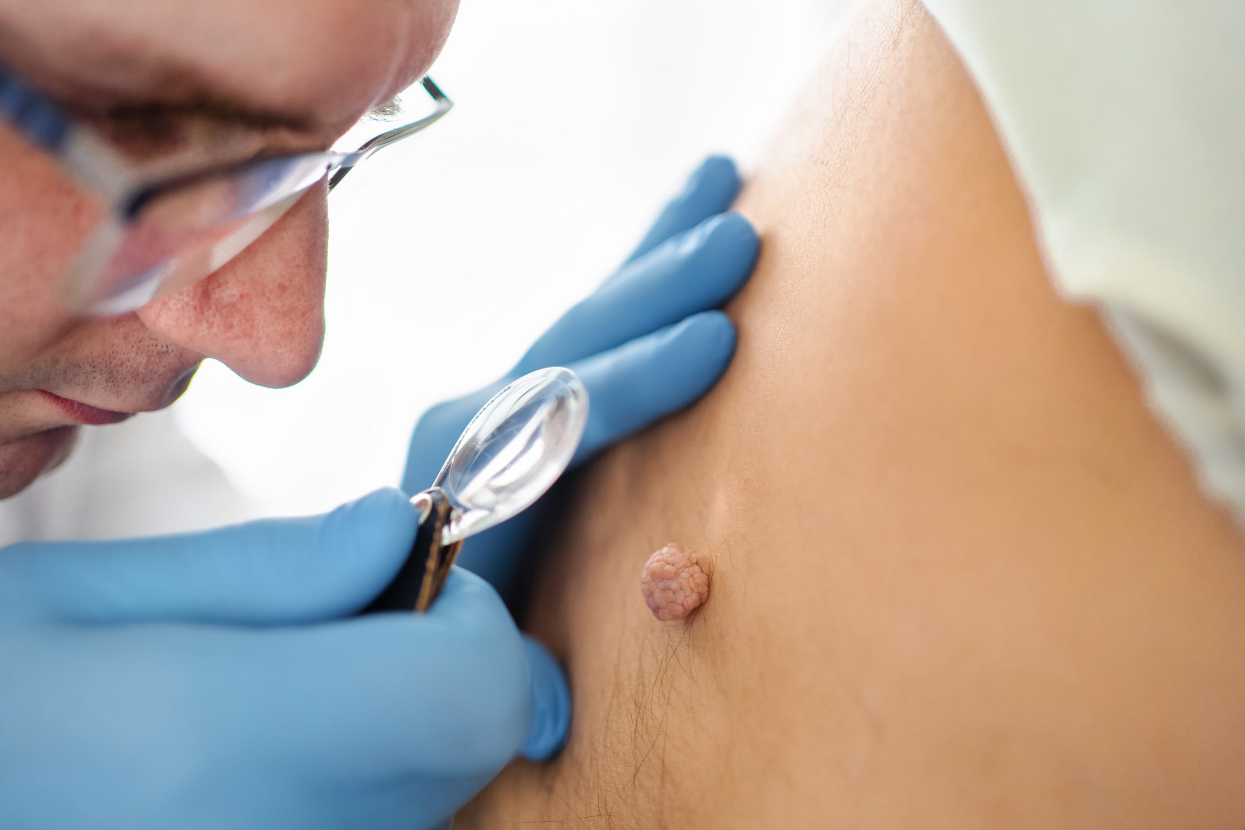 ¿La picazón en la piel es un signo de cáncer?