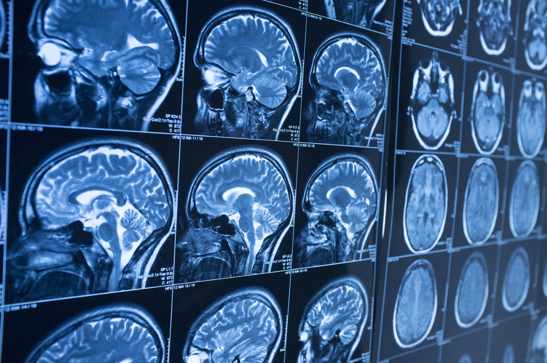 Diferencias entre Parkinson y temblor esencial: cómo identificar cada uno y cuándo acudir al médico